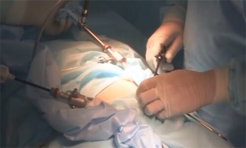 лапароскопическая миомэктомия